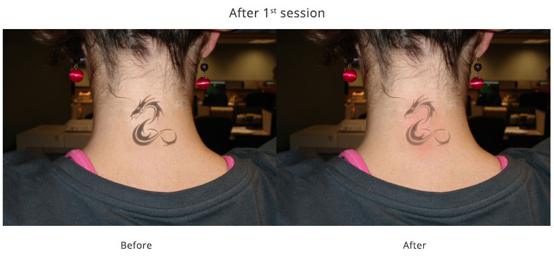 Laser Tattoo Removal Before And After