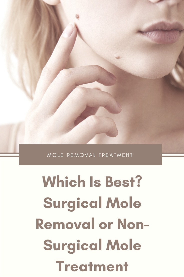 Which is Best? - Surgical Mole Removal or Non-Surgical ...