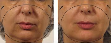 OxyGeneo Facial Treatment in Dubai