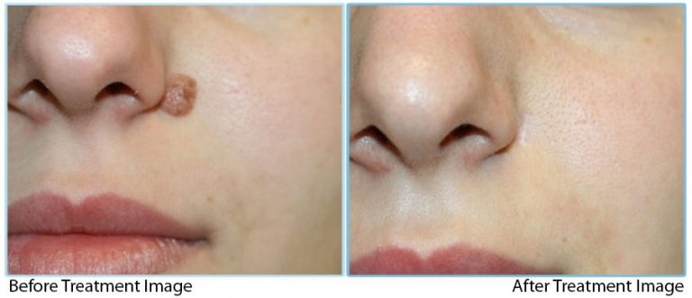 Skin-Lesion-Removal-in-Abu-Dhabi-768x331