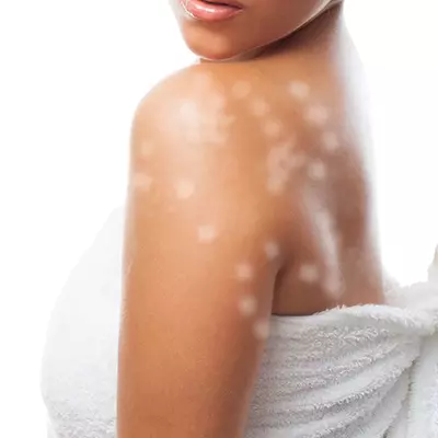 Vitiligo: Why It Happens To You, And How To Treat It?, 52% OFF